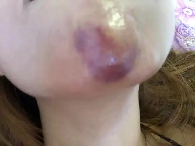 打玻尿酸下巴淤血有没有事?能好吗?