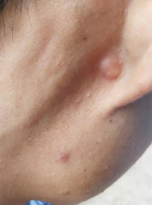 我的耳朵后面有个小疙瘩,请问这是瘊子吗?感觉不像啊!