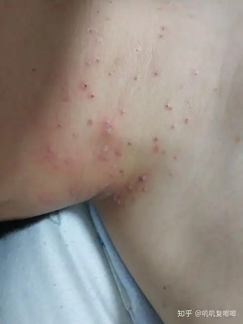 丝状疣脖子上女性医生说要激光扫有别的办法吗