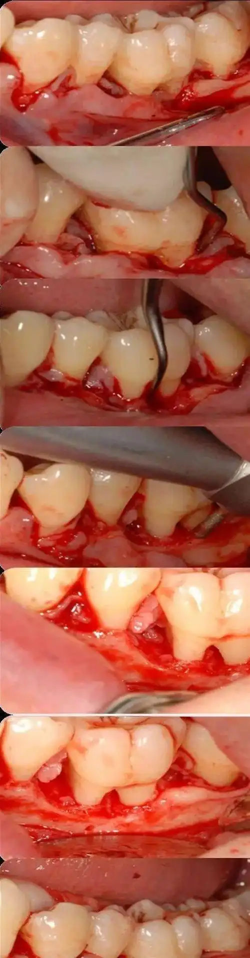 成人慢性牙周炎系统性治疗一例 | 以菌斑控制为导向的牙周治疗2018