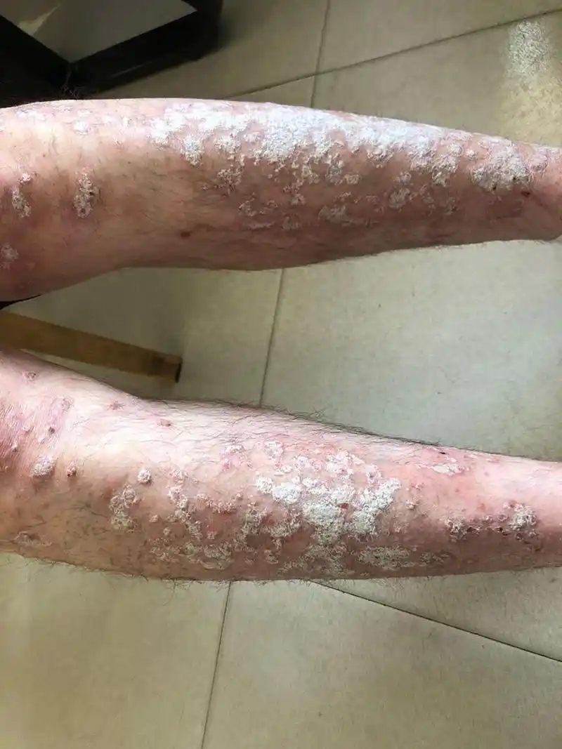 银屑病 一旦出现这种皮疹 ,就不能 再依赖清热解毒的方法进行治疗了