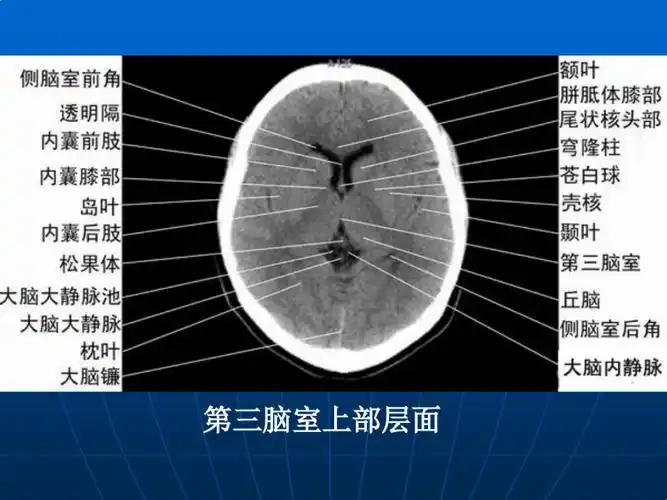 第三脑室上部层面