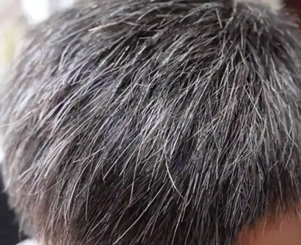 白头发可以拔掉吗?_头皮_年轻人_问题