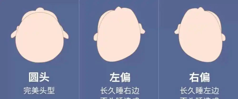 但是成人的颅骨已经基本发育成型,只能靠发型缓解了.