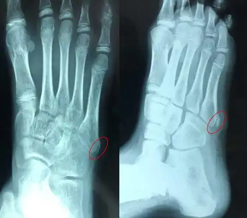 小朋友活动后足外侧疼痛明显,到底是怎么回事?_疼痛 - 好大夫在线