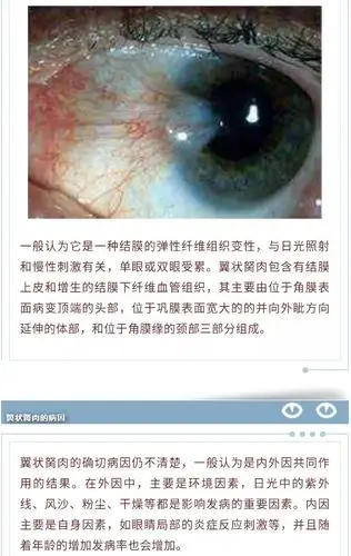 【友谊科普】眼睛里长"息肉",要当心翼状胬肉!