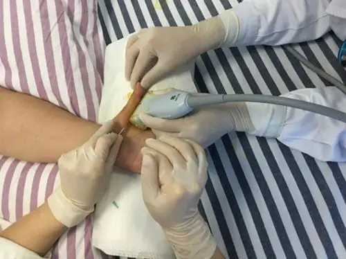 小针刀治疗图片