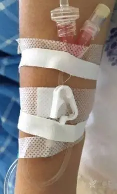 留置针固定:必须要 u 型吗,怎么固定才最合适?