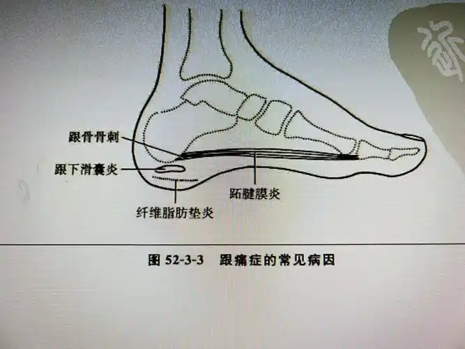 (1)口服非甾体类抗炎药,局部热疗或理疗,外用活血通络药物.