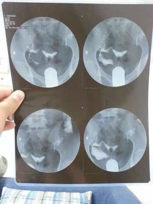 输卵管造影片子有懂得吗?