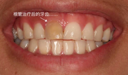 简而言之,根管治疗就是将牙齿内部感染的牙髓(「牙神经」)去除干净,再