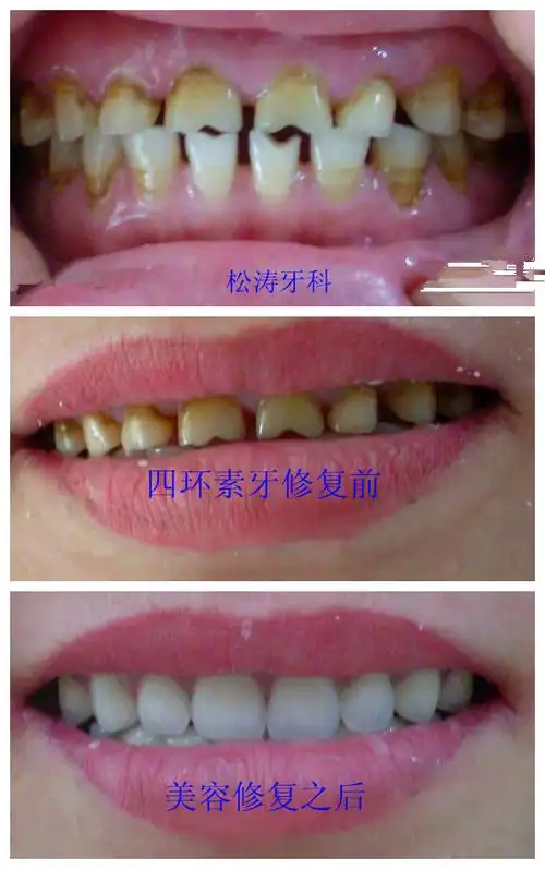 图片说明: 四环素牙修复