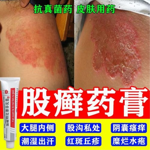 盐酸特比萘芬乳膏20g 股癣专用药膏 股癣膏大腿内侧臀部真菌感染 阴囊