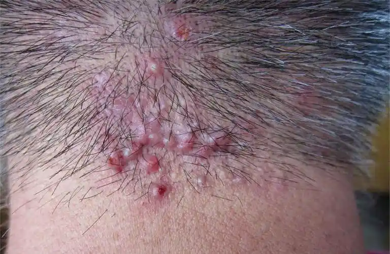 腿上毛囊炎的症状图片(项部瘢痕疙瘩性毛囊炎) - 赤虎壹号