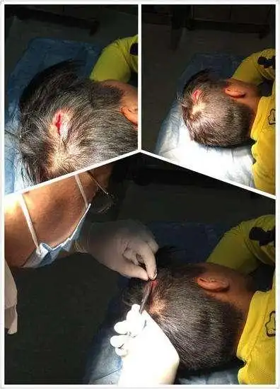 头部受伤后,你需要知道的那些事!