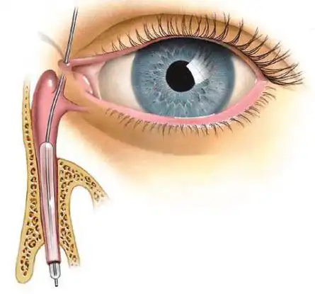 什么是泪管阻塞