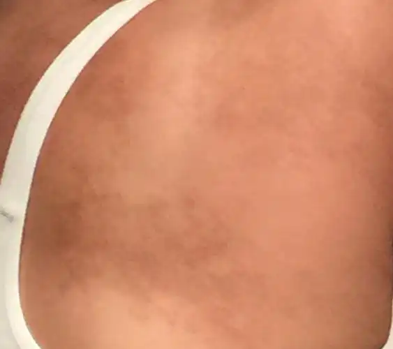 背部有褐色的斑,很多年了,摸起来有小颗粒,粗糙,不痛不痒,这个是什么?