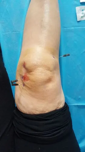 【预告】弧刃针疗法学术报告,3月18日走进武陟仁德骨科医院