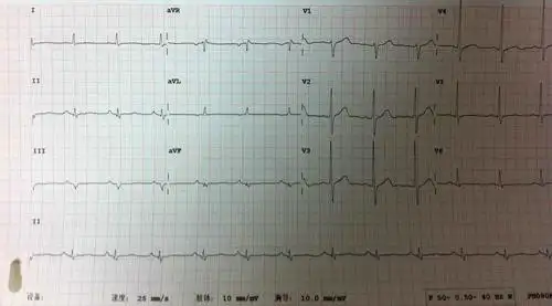 请问老师这个是异常q波吗 - 心电图脑电图专业讨论版 - 爱爱医医学