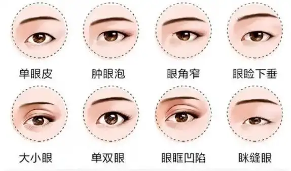 ▼图片科普:眼综合适合哪些眼型合肥韩宫做眼睛好的