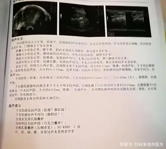 子宫腺肌症有哪些症状,该如何治疗?妇科专家:这3个方法有效