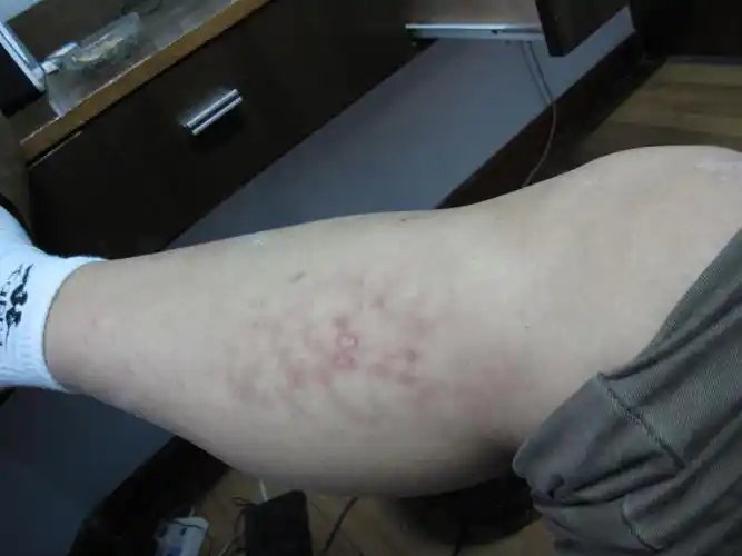 请专家看看什么病,谢谢 - 皮肤及性传播疾病讨论版 - 爱爱医医学论坛