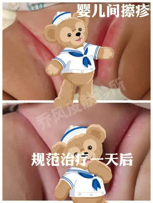 我真的没有过宝宝红屁屁的困扰上图是用完第二天的效果医美术后微小