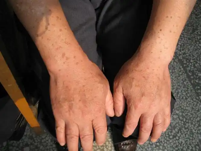 男,55岁.手背多发性小斑丘疹20年,不痛不痒,越来越多.是扁平疣吗?