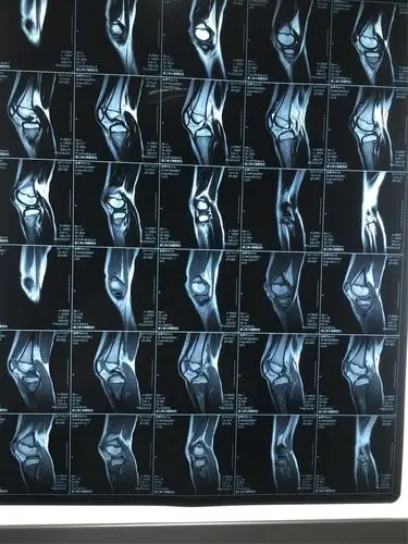 左胫骨近段 急性骨髓炎病例.包秀气 男.9岁