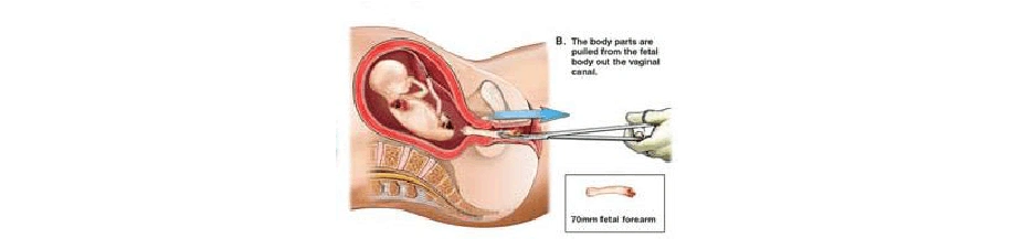 人工流产全过程(图)