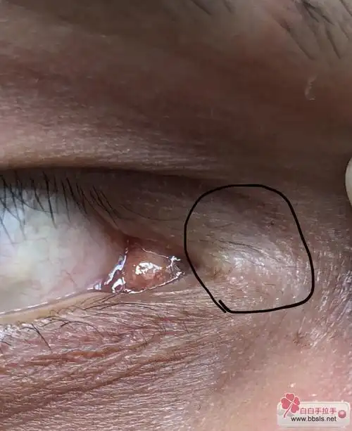 内眼角伍德灯下发白,会是白癜风吗?