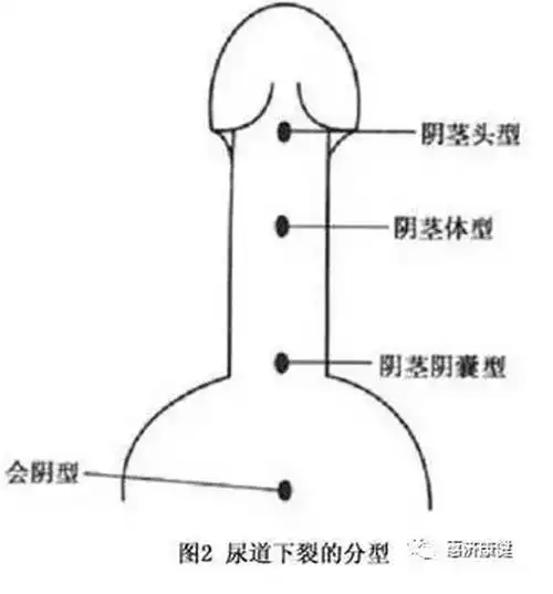 家里"小王子"小鸡鸡一出生就是弯的,到底是怎么了? - 好大夫在线