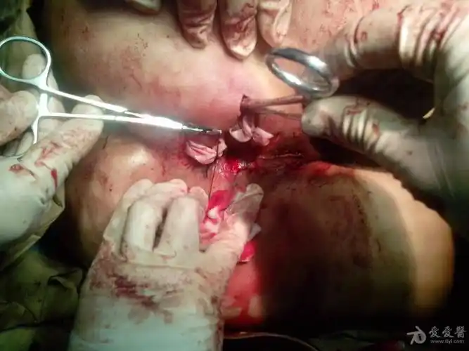 新手做的肛周脓肿 请老师们指点