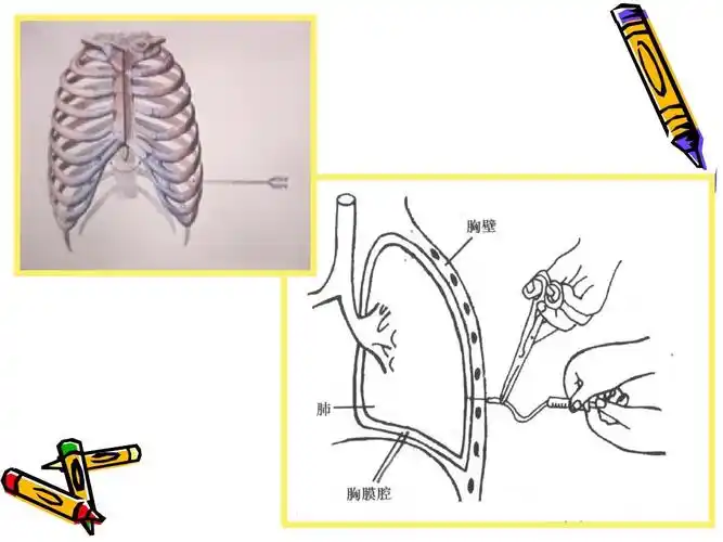 胸腔穿刺术ppt