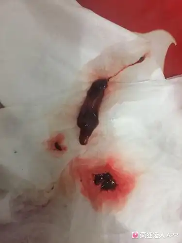 这是孕囊吗?我看不懂