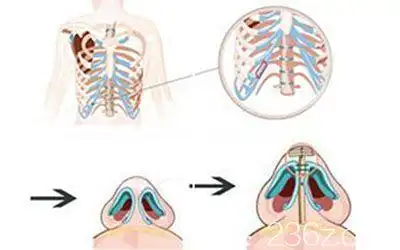 肋软骨隆鼻卡通示意图
