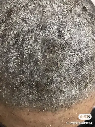 头皮牛皮廯头皮屑头皮痒头皮藓病一大块头皮
