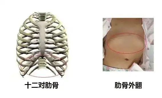 很多宝宝平躺时会有肋骨外翻的症状,妈妈们遇到这种情况往往很容易