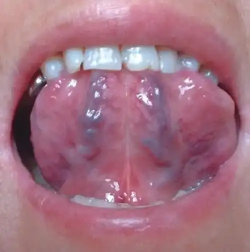 看病先断病:舌下络脉辨证真法(附歌诀) - 美篇