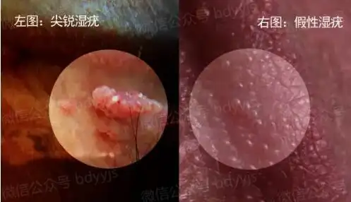 假疣和真疣的区别-顾花初级护师-爱问医生