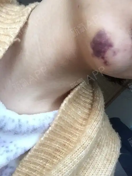 一周,下巴这样,由青到青紫到紫,估计还得一周才能消