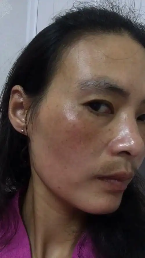 面部红疙瘩出现晒斑以后应当怎样补救