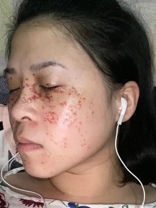 激光祛斑后第二天