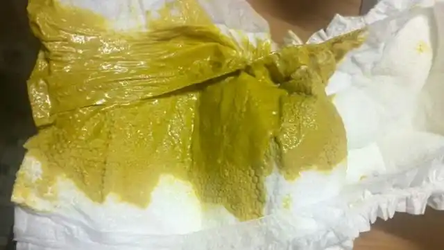 宝宝大便稀,怎么办?