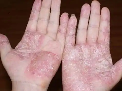 所以在手癣出现之前就要提前对于这些可能的病菌进行预防,医院主任给