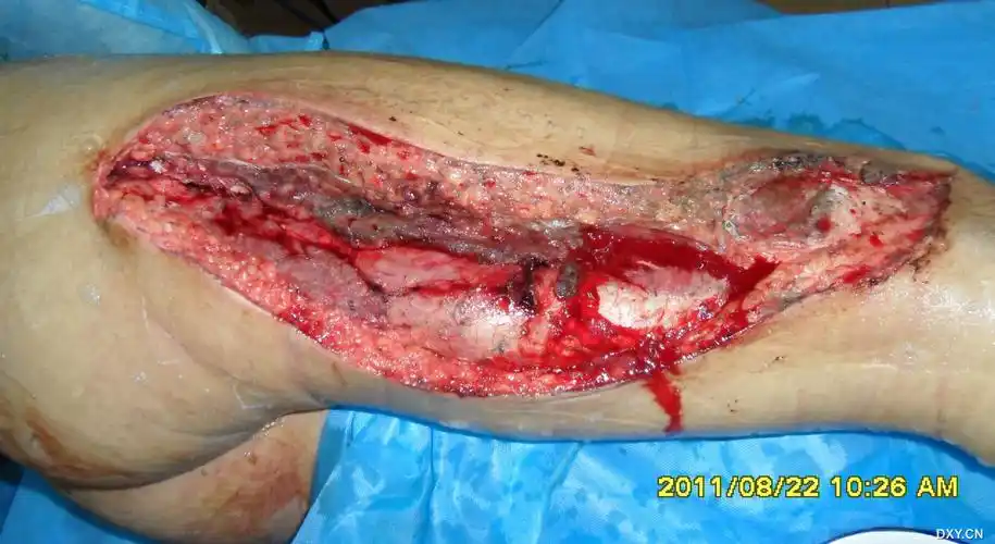 这个小腿该如何处理,截肢or 保肢? [病例帖]