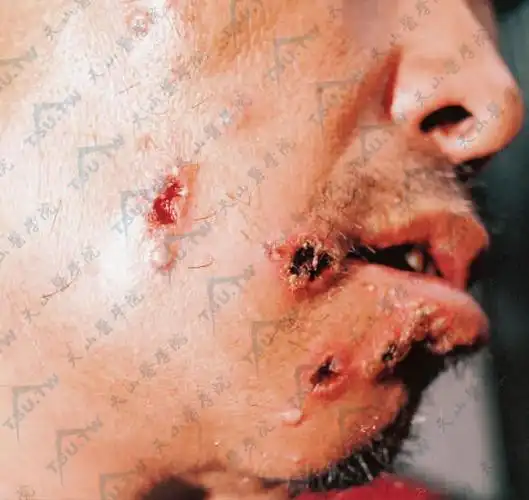 炭疽(炭疽杆菌感染)病因,症状,诊疗参考 - 皮肤病学 - 天山医学院