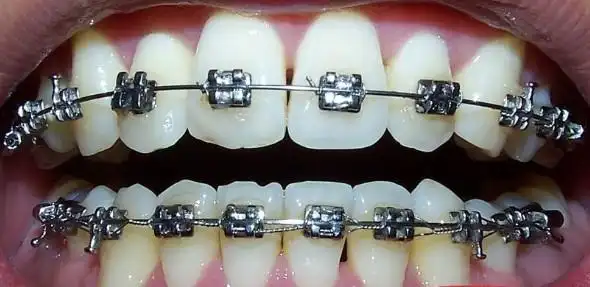 深圳牙齿矫正之后会唔会影响食嘢?