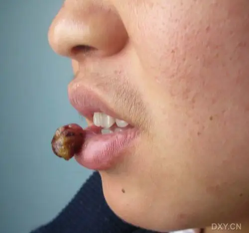 【求助】请教各位前辈,这个嘴唇上的是血管瘤么?