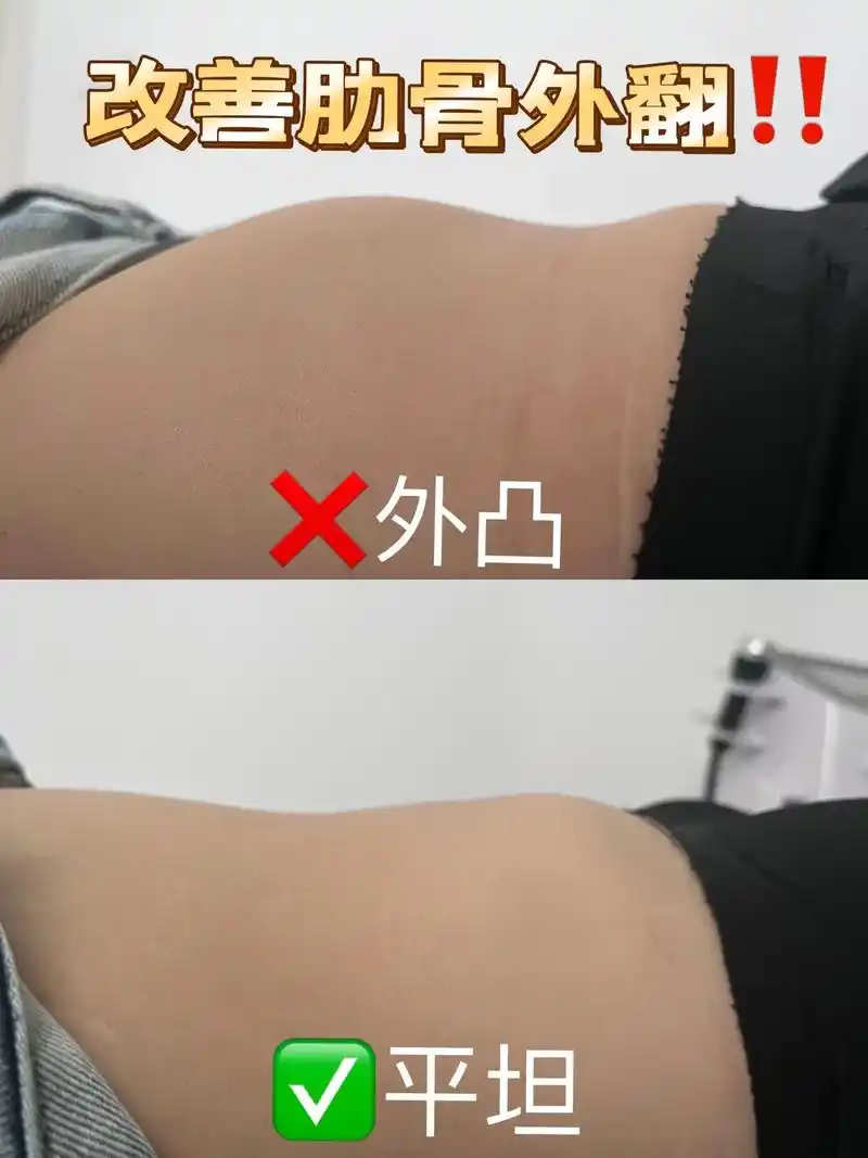 矫正肋骨外翻,亲测腰腹会变细6015.